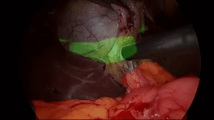 GoNoGoNet surgical computer vision demo